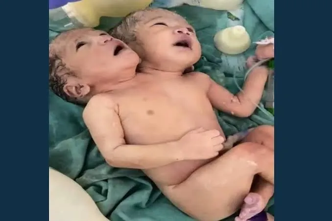 A unique girl born with two heads