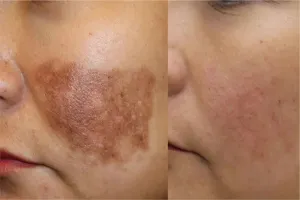 ਚਿਹਰੇ ਦੇ ਦਾਗ-ਧੱਬੇ ਅਤੇ ਛਾਈਆਂ (Pigmentation) ਜੜ੍ਹ ਤੋਂ ਖਤਮ ਕਰਨ ਦੇ ਸਭ ਤੋਂ ਕਾਰਗਰ ਘਰੇਲੂ ਉਪਾਅ
