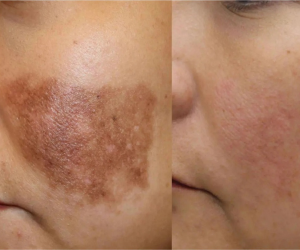 ਚਿਹਰੇ ਦੇ ਦਾਗ-ਧੱਬੇ ਅਤੇ ਛਾਈਆਂ (Pigmentation) ਜੜ੍ਹ ਤੋਂ ਖਤਮ ਕਰਨ ਦੇ ਸਭ ਤੋਂ ਕਾਰਗਰ ਘਰੇਲੂ ਉਪਾਅ